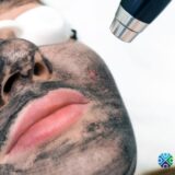 carbon laser