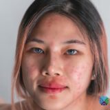 rosacea